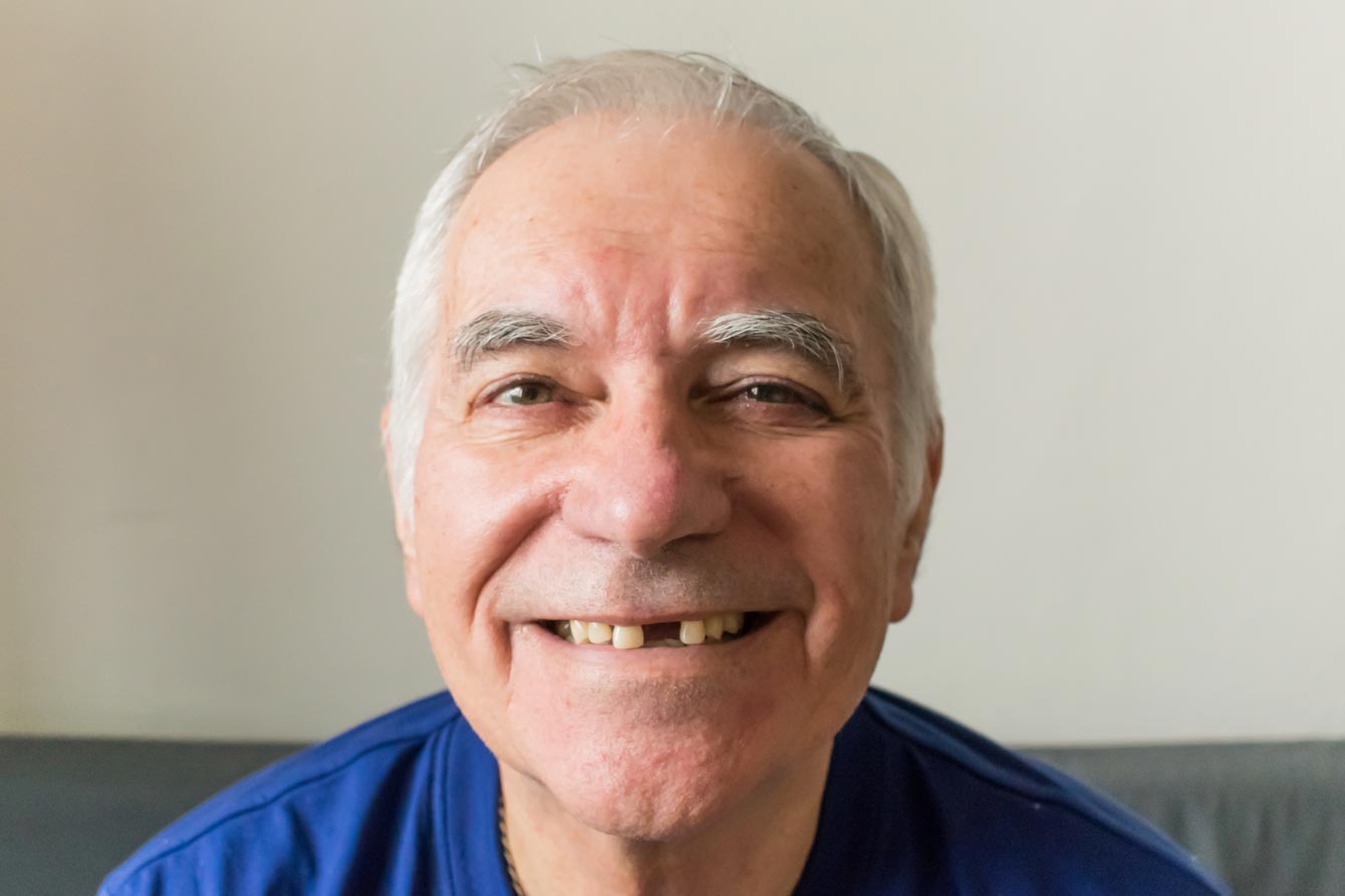 Closeup of older man with smile revealing missing front teeth